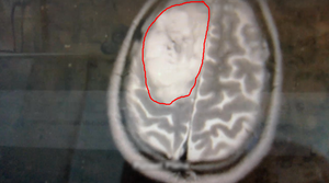 Gary from the top Top view of the tumor.