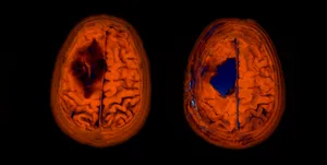 Comparing imaging before / after for my brain