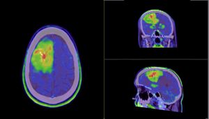 PET scan results for Gary. PET Scan of the tumour.