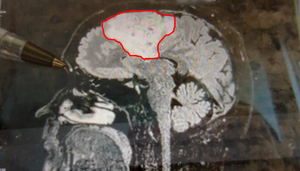 Gary from the side. Side view of the tumor.