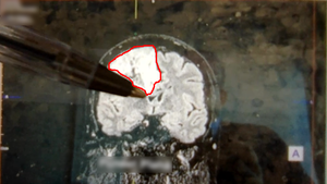 Gary from the back. Back view of the tumor.